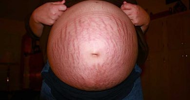 get rid of stretch marks bleeping world