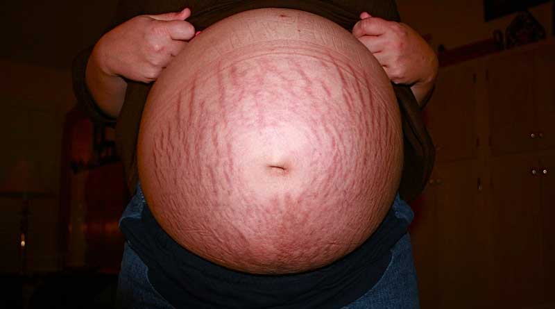 get rid of stretch marks bleeping world