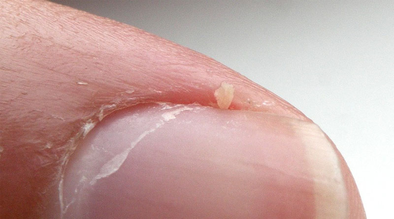 nails peeling and splitting - BleepingWorld