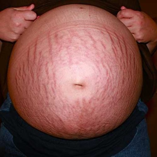 Tips on How to Get Rid of Stretch Marks